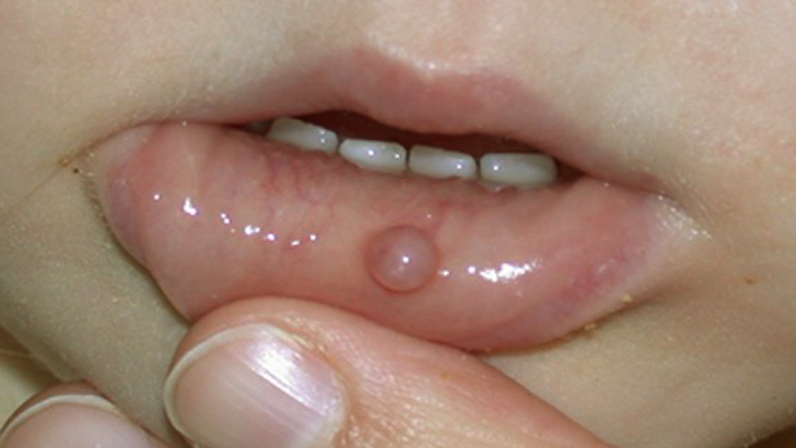 মুখে ঘা হলে কী করবেন?