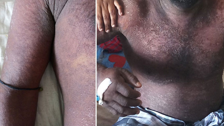 রক্তদানের পর শরীরে যেসব লক্ষণে বিপদ!