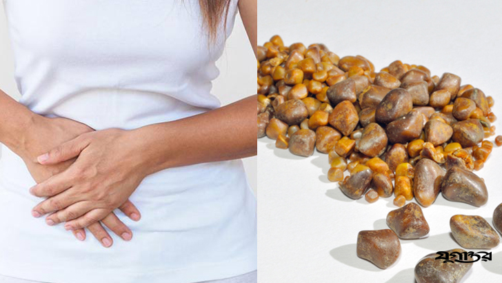 যেসব লক্ষণে বুঝবেন পিত্তথলিতে পাথর