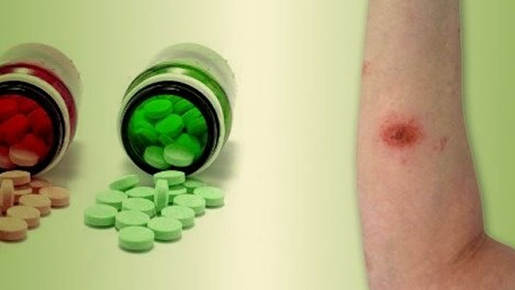 শরীরে একজিমা হলে করণীয় কী?