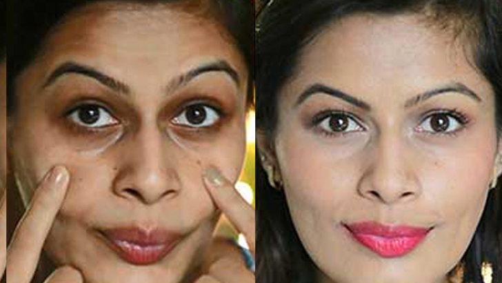 মেছতার দাগ দূর করার ঘরোয়া উপায়