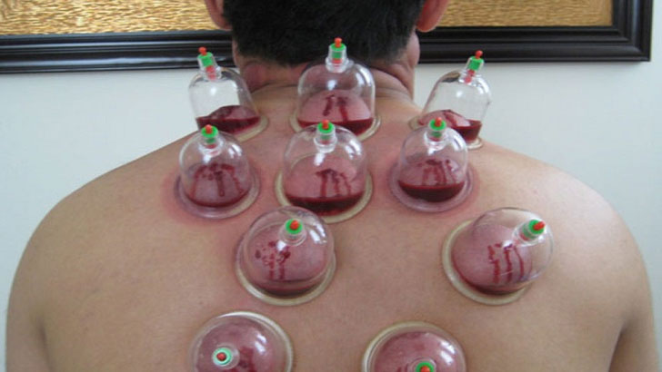 হিজামা নয়, বিজ্ঞানসম্মত চিকিৎসা গ্রহণই রাসূলের সুন্নত