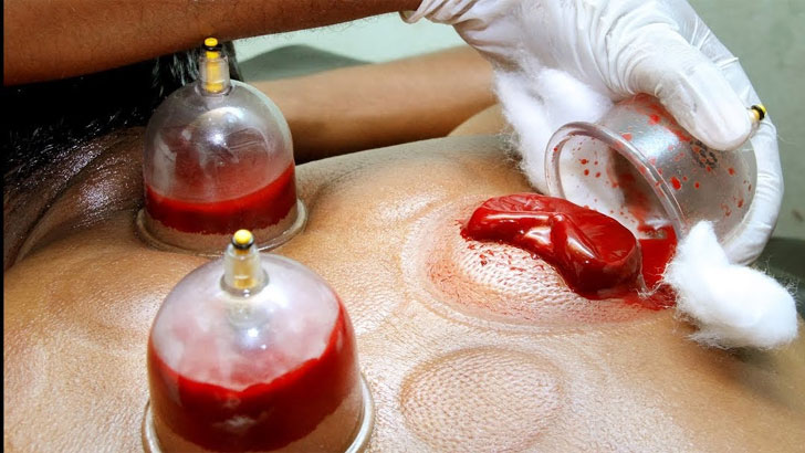 হিজামা না রক্তদান কীসে বেশি উপকারিতা?