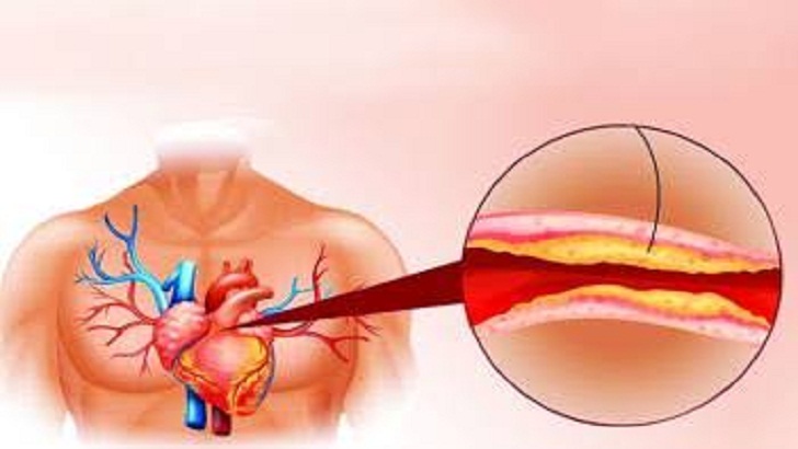 কোলেস্টেরল কমানোর ওষুধ সম্পর্কে সাবধান হতে হবে