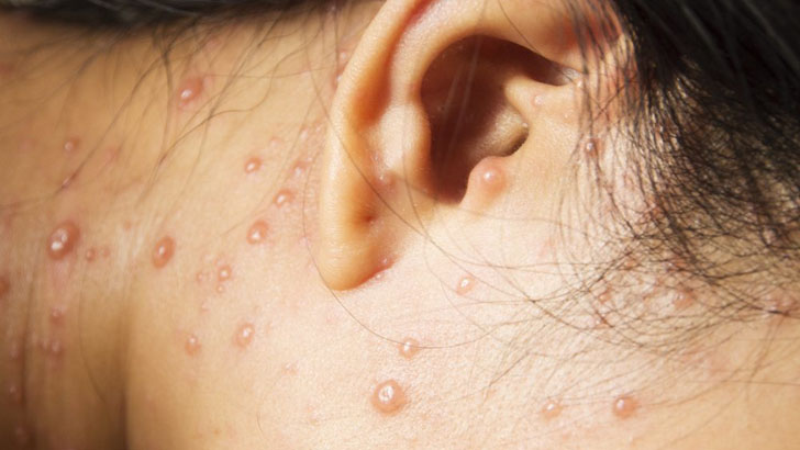 যেসব লক্ষণে বুঝবেন চিকেন পক্স