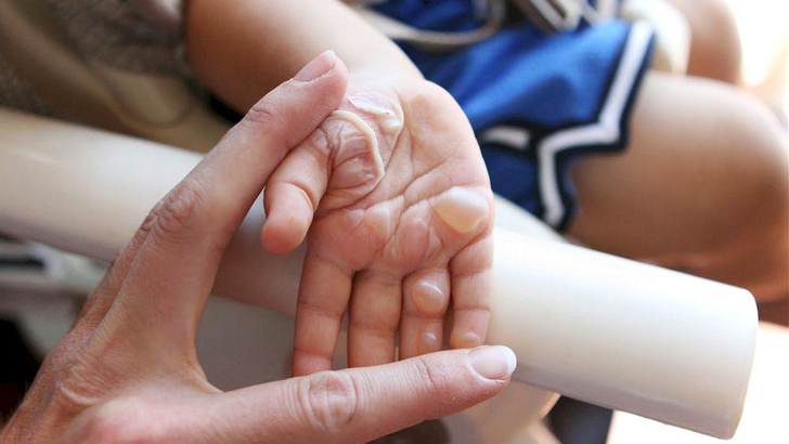 গরম তেল ও আগুনে হাত পুড়লে কী করবেন