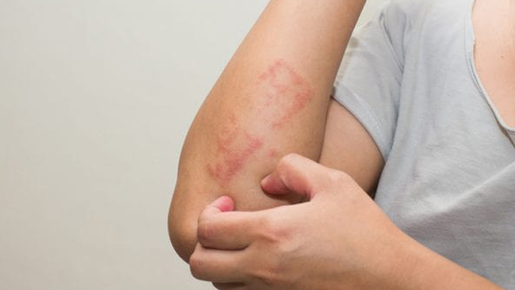 গরমে যেসব চর্মরোগ হতে পারে, কী করবেন 