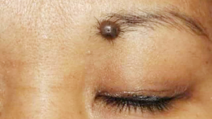 ত্বকে আঁচিল ও কালো দাগ সমস্যায় কী করবেন