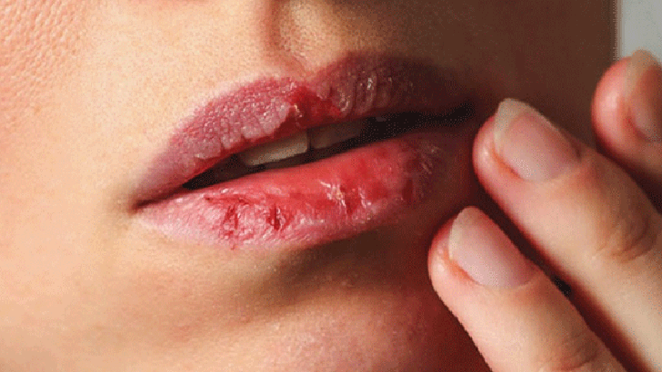 ঠোঁট ফাটা রোধে মধুর ৪ ব্যবহার 