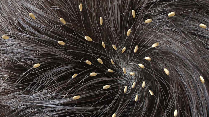 উকুন তাড়ানোর ঘরোয়া ৫ উপায়