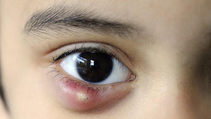 চোখে অঞ্জনির ব্যথা, কী করবেন