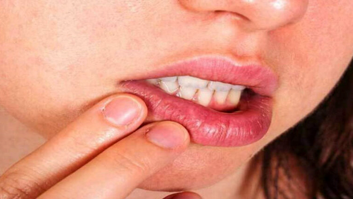 মুখের আলসার ভালো হচ্ছে না, কী করবেন?