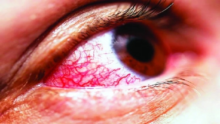 যেসব অপারেশনের পর চোখে ইনজেকশন নেওয়া লাগে