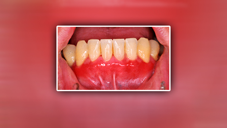 সিস্টেমিক আলসার এমএমপি ও এর চিকিৎসা