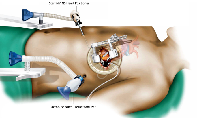 দেশে প্রথম এমআইসিএস পদ্ধতিতে হার্টের ডাবল ভাল্ব প্রতিস্থাপন