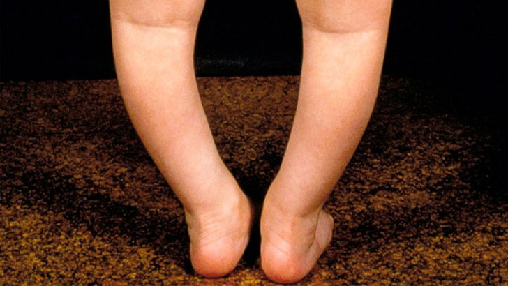 শিশুর পা বাঁকা রোগ কেন হয়, কী করবেন