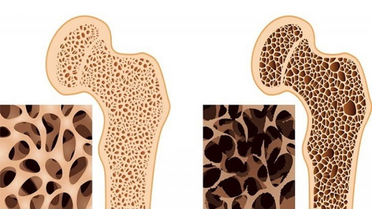 নারীদের হাড়ের ক্ষয়রোধে গুরুত্বপূর্ণ কিছু পরামর্শ