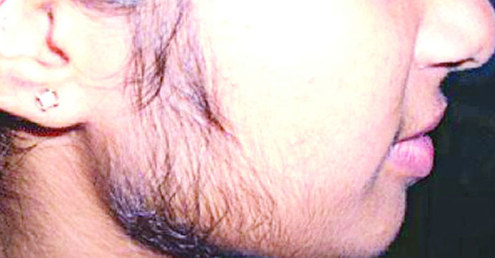 মেয়েদের মুখে যে কারণে দাড়ি ওঠে