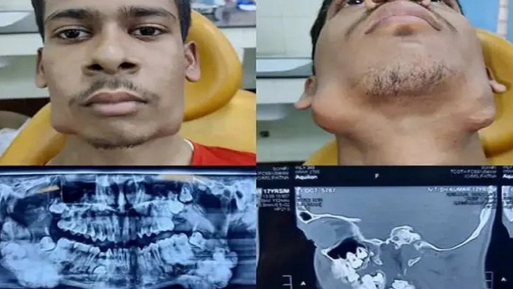 কিশোরের এক চোয়ালেই ৮২ দাঁত! (ভিডিও)