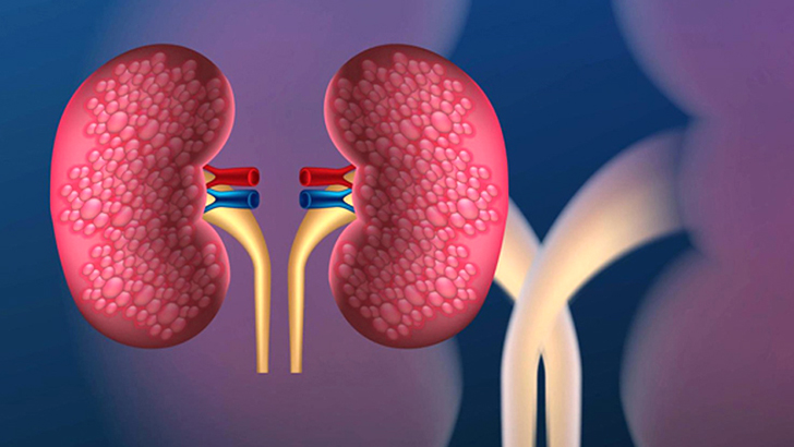দুটি বিষয় নিয়ন্ত্রণে থাকলে এড়ানো যায় কিডনি জটিলতা