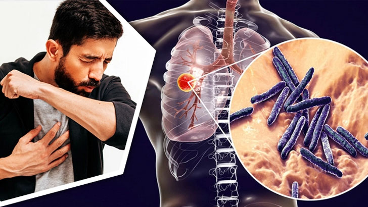 যক্ষ্মার ঝুঁকি কাদের বেশি,  কী করবেন?