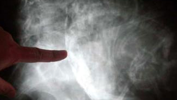 ‘স্টোন বেবি’ কি