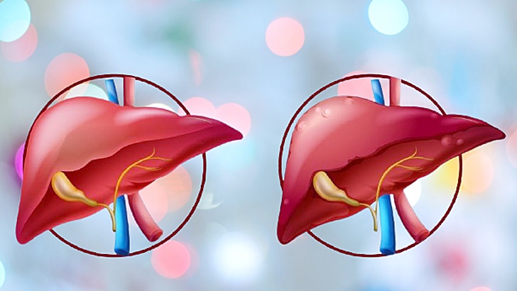 দেশের ২৯ ভাগ মানুষ ফ্যাটি লিভারে ভুগছে
