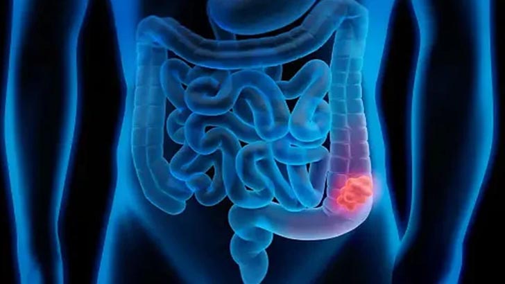 চিনি ও লাল মাংসে তরুণদের হতে পারে কোলোরেক্টাল ক্যানসার: গবেষণা