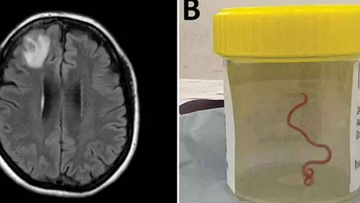 মানুষের মগজে জীবন্ত কৃমি