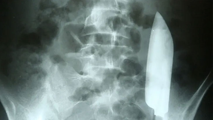 পেট থেকে বের হলো ১৫ ইঞ্চি ছুরি