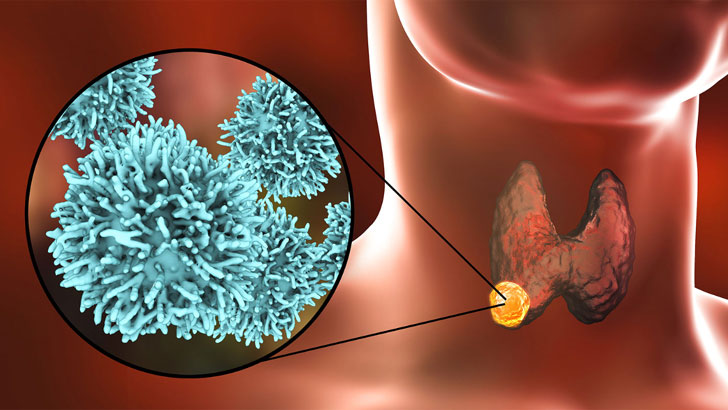 তিন দশকে থাইরয়েড ক্যানসার বেড়েছে ২০০ গুণ