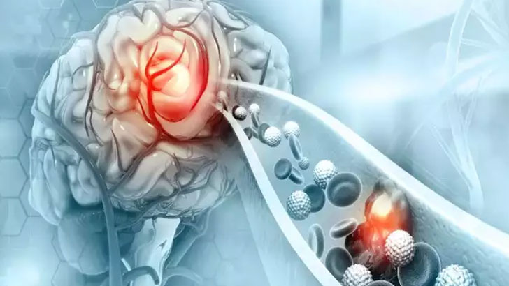 দেশে মৃত্যুর তৃতীয় কারণ স্ট্রোক