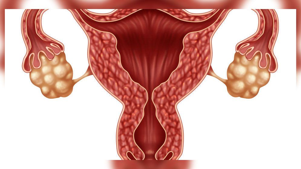 পলিসিস্টিক ওভারি থেকে মুক্তি পেতে ৪ খাবার
