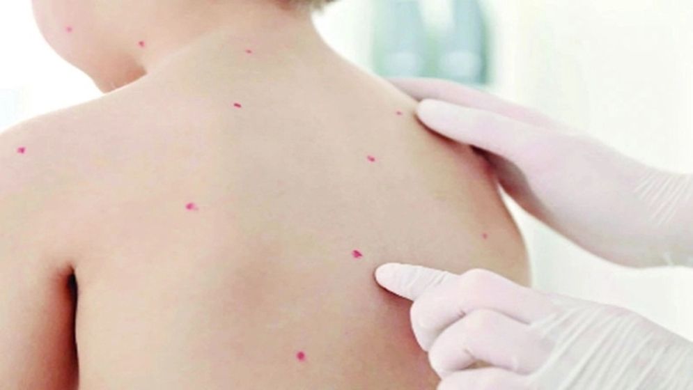 যা দেখে বুঝবেন চিকেন পক্স কেন হয়, জেনে নিন এর সমাধান