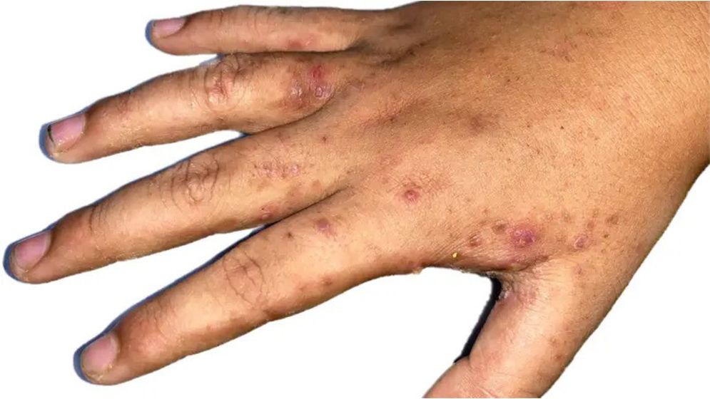 ছোঁয়াচে ‘স্ক্যাবিস’ রোগের সংক্রমণ বাড়ছে কুমিল্লা ও রাজশাহীতে, কারণ ও প্রতিকার কী?