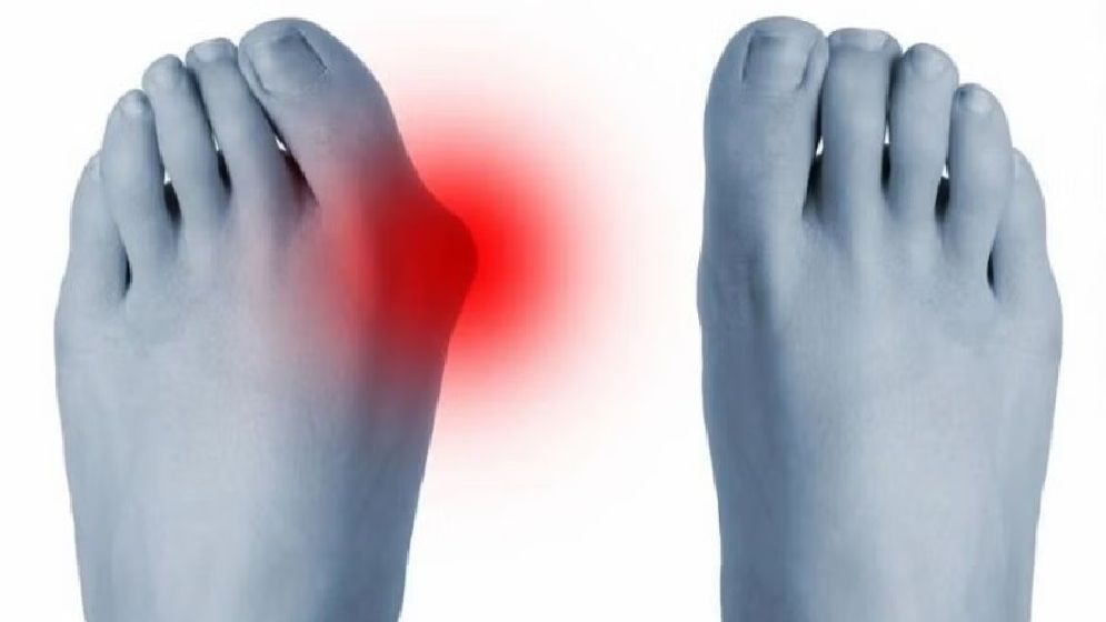 ইউরিক অ্যাসিড বেড়ে গেছে? নিয়ন্ত্রণের সহজ উপায়