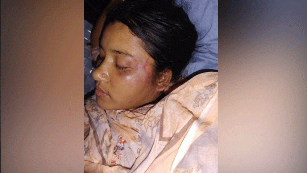 যৌতুক না পেয়ে স্ত্রীর পা ভেঙে দিল স্বামী