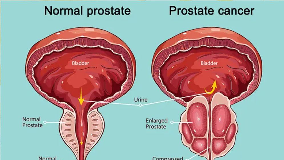 চল্লিশের পর বাড়ে প্রোস্টেট ক্যানসার ঝুঁকি, কী কী স্বাস্থ্য পরীক্ষা করে রাখা জরুরি
