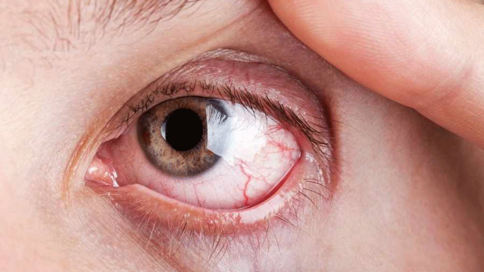 রক্তচাপ কেড়ে নিতে পারে দৃষ্টিশক্তি