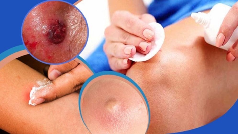 বিষফোড়া থেকে মুক্তির ঘরোয়া উপায় জানুন