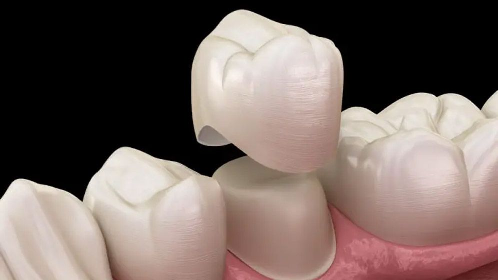 দাঁতে ক্যাপ লাগানো থাকলে ওজু-গোসল হবে?