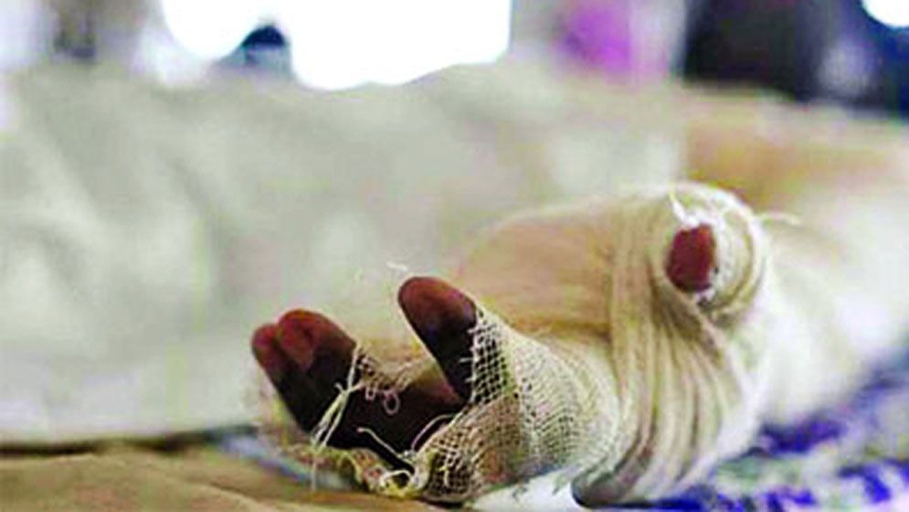 আগুনে পোড়া রোগীর এতো রক্ত লাগে কেন?