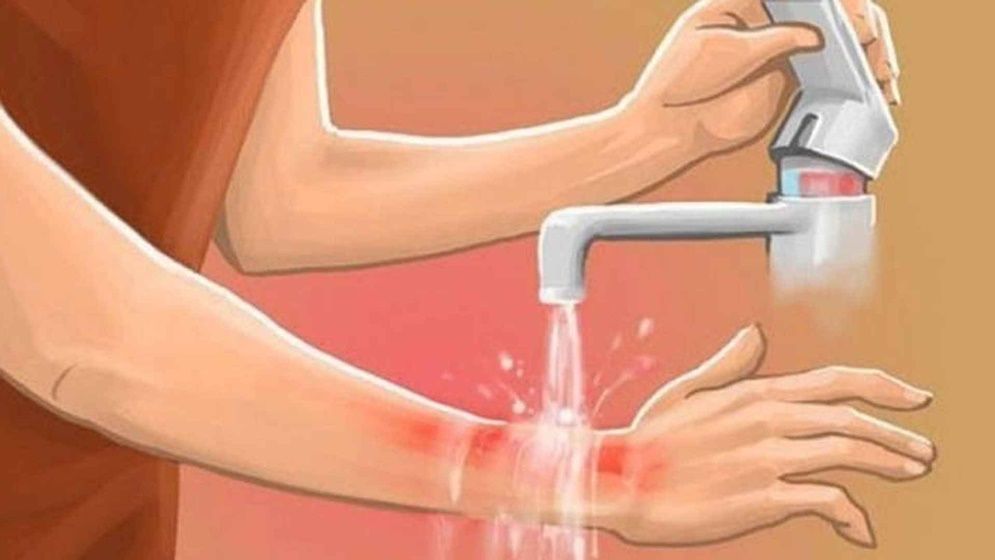 আগুনে পোড়া রোগীর চিকিৎসাসেবা