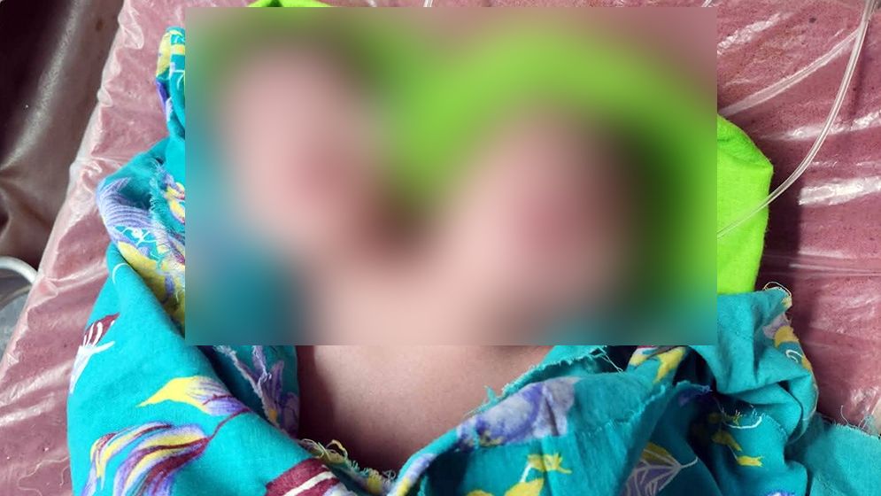 রাজশাহীতে দুই মাথা নিয়ে শিশুর জন্ম