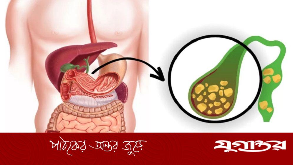 পিত্তথলিতে পাথর কেন হয়, কারা বেশি ঝুঁকিতে?