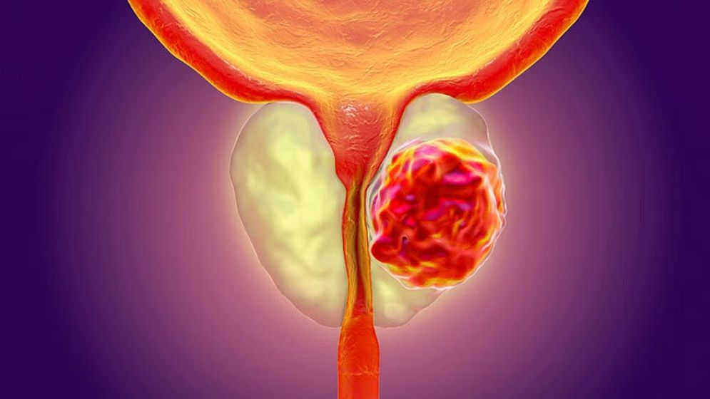 প্রোস্টেট ক্যান্সারে রেডিওথেরাপি: অগ্রগতি, বাংলাদেশের বাস্তবতা ও করণীয়