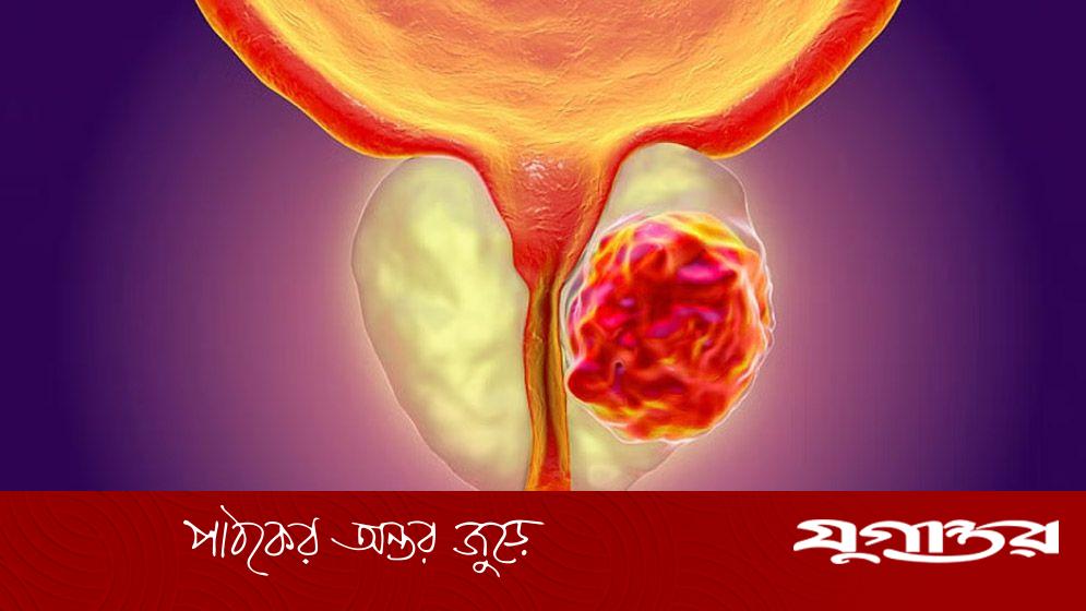 প্রোস্টেট ক্যান্সারে রেডিওথেরাপি: অগ্রগতি, বাংলাদেশের বাস্তবতা ও করণীয়