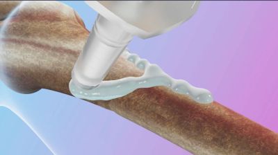 আঠা দিয়ে মাত্র ৩ মিনিটে জোড়া লাগবে হাড়