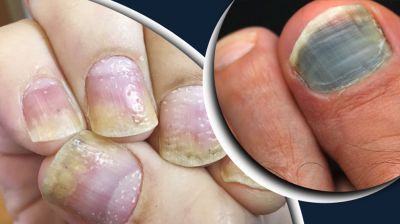 নখের রং বদল: যেভাবে বুঝবেন শরীরে ক্যানসার বাসা বেঁধেছে