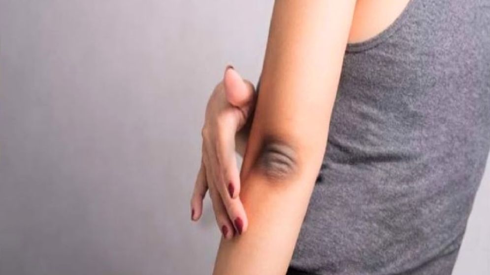 কনুই ও হাঁটুর কালচে দাগ দূর করার ৩ উপায়